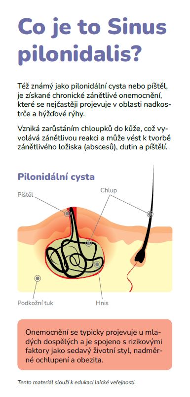 Sinus-pilonidalis